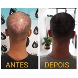 micropigmentação de cabelo masculino agendar Vila Mariana
