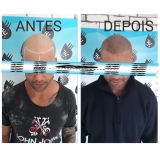 micropigmentação de cabelo masculino preço Francisco Morato