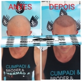 micropigmentação de cabelo masculino Ferraz de Vasconcelos