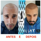 micropigmentação fio a fio barba preço Higienópolis