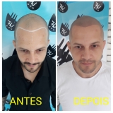 micropigmentação masculina cabelo agendar Santo André