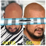 micropigmentação masculina cabelo preço Poá