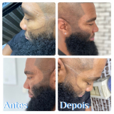 micropigmentação na barba Sé