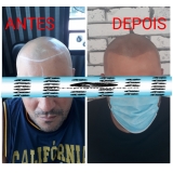 micropigmentação no cabelo agendar São Caetano