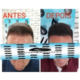 micropigmentação no cabelo preço Itaquaquecetuba