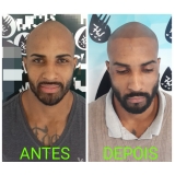 micropigmentação preenchimento cabelo Ibirapuera