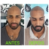 micropigmentação preenchimento cabelo São Mateus