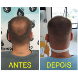 nano micro capilar valor Grajau