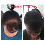 nano pigmentação da barba valor Ponte Rasa