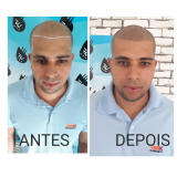 nano pigmentação de barba valor Salesópolis