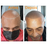 nano pigmentação na barba preço Vila Buarque