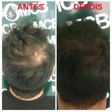 onde encontrar clínica de pigmentação no couro cabeludo José Bonifácio