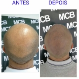 onde encontro clínica de pigmentação capilar para homens Poá