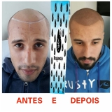 onde encontro preenchimento capilar masculino Interlagos