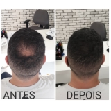 onde fazer micropigmentação capilar cabelo branco Itaim Bibi