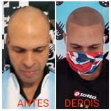 preço de micropigmentação cabelo feminino Ermelino Matarazzo