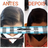 preço de micropigmentação cabelos Santo André