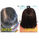 preço de micropigmentação capilar cabelo grande Parelheiros