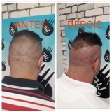 preço de micropigmentação preenchimento cabelo Jardim Ângela
