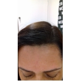 quanto custa preenchimento capilar em mulheres Pari