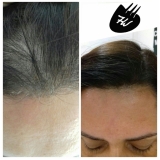 tratamento de calvície feminina Vila Carrão