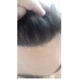 tratamento para a calvície feminina Mandaqui