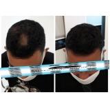 valor de micropigmentação cabelo homem Ponte Rasa