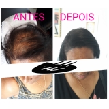 valor de micropigmentação cabelo masculino Jardim São Paulo