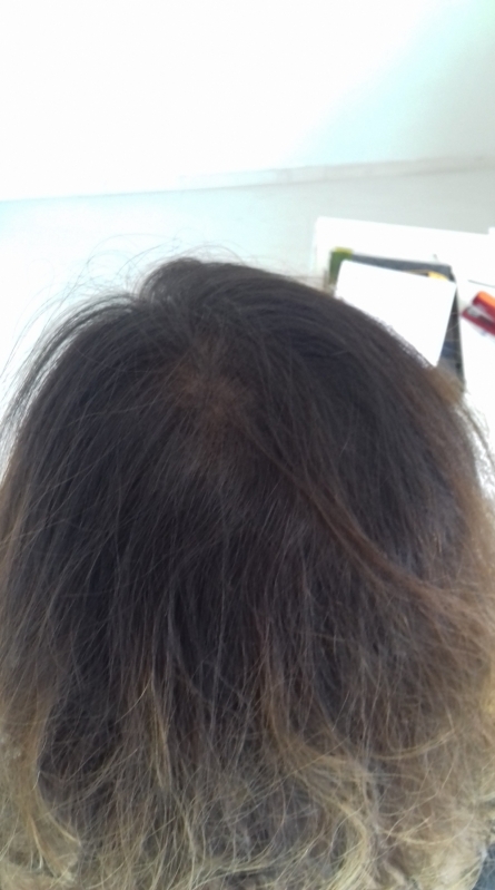 Tratamento para a Calvície Feminina Preço Cajamar - Tratamento para Calvície com Pigmentação