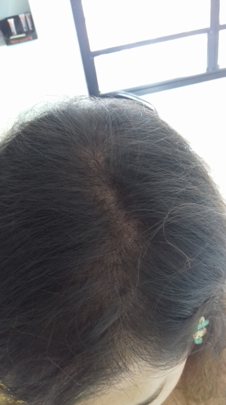 Tratamentos para a Calvície Feminina Pacaembu - Tratamento de Calvície Natural