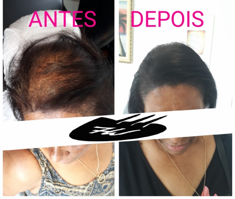 Valor de Micropigmentação Cabelo Masculino Pacaembu - Micropigmentação de Cabelo Masculino