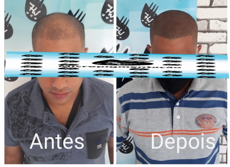 Valor de Micropigmentação Cabelo Embu Guaçú - Micropigmentação Capilar Cabelo Branco